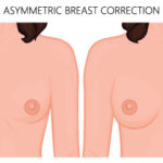 Breast-asymmetry-Melbourne-Top-Plastic-Surgeon