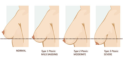 Breast Ptosis Breast Lift Sydney Dr Kernohan best breast lift sydney - breast lift cost sydney