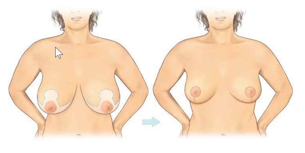 Breast Reduction Incision - Wise Pattern Anchor Incision - Best Breast Reduction Surgeon Sydney Dr Kernohan Campbelltown - Breast Reduction Sydney