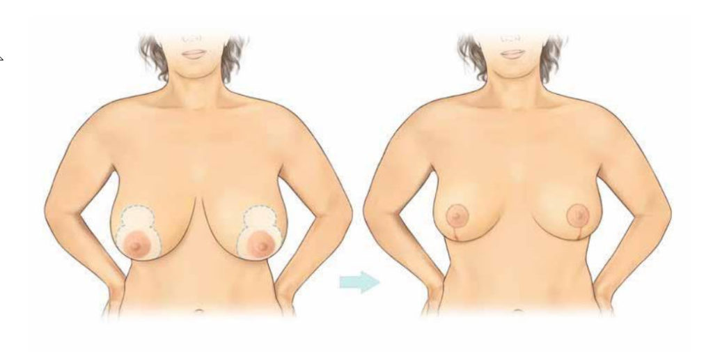 Breast Reduction Le Jour Vertical Scar Pattern - Best Lollipop Breast Reduction in Sydney Dr Kernohan - Breast Reduction Sydney