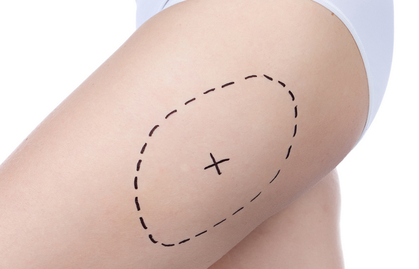 Thigh Lift Sydney Australia Procedure Dr Michael Kernohan