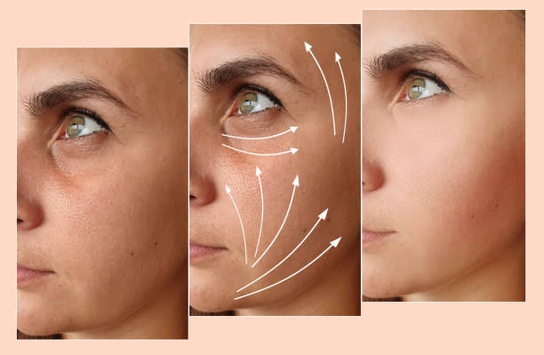 Recovery Ponytail Facelift Sydney Dr Kernohan
