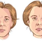 facial-nerve-surgery_facial-paralysis_Dr-Kernoahn_Sydney