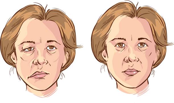 Facial Nerve Surgery Facial Paralysis Dr Kernoahn Sydney AU