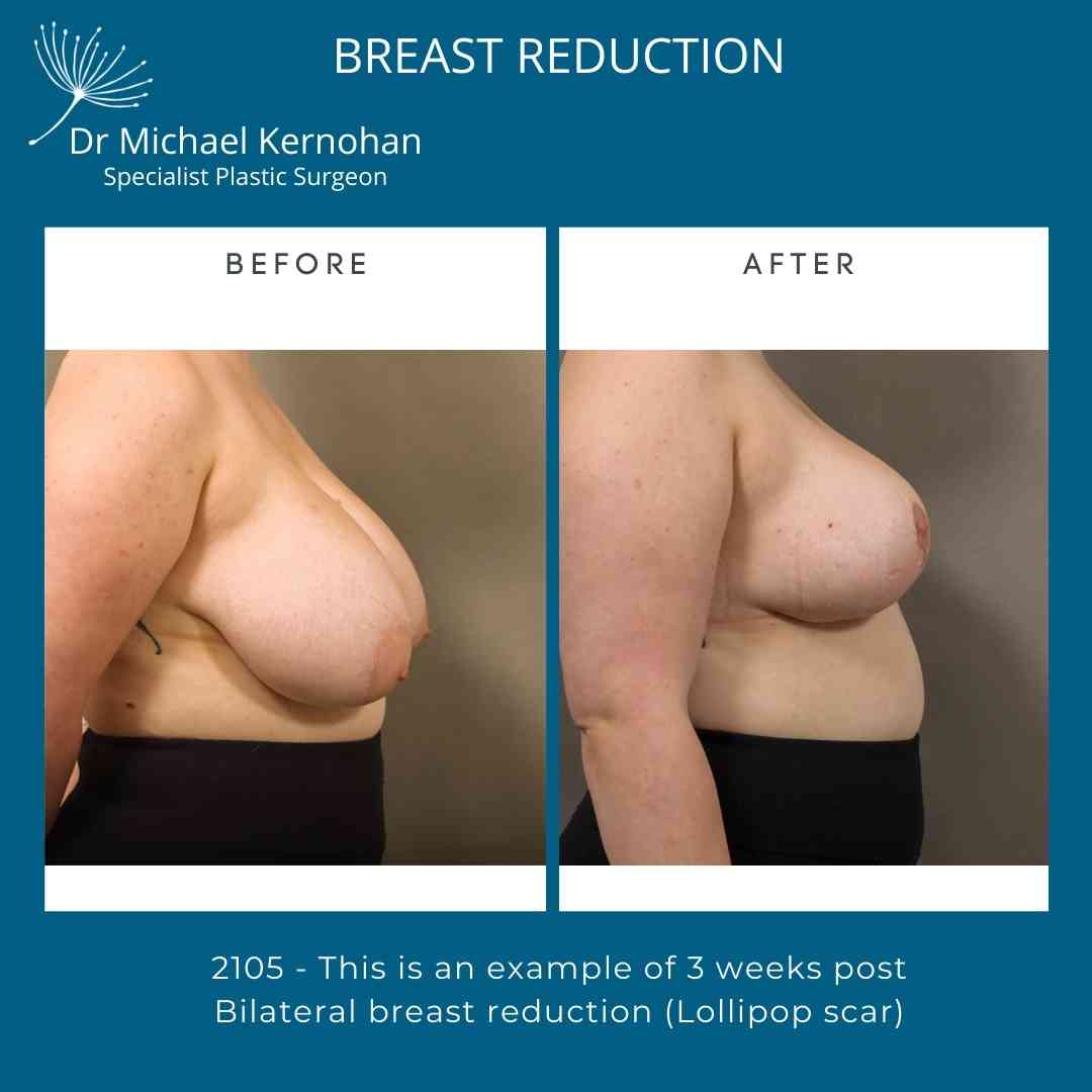 Breast Reduction Before and After by Dr Michael Kernohan