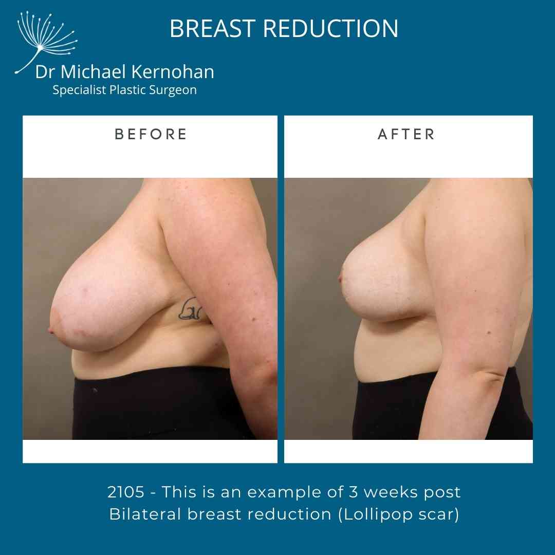 Breast Reduction Before and After by Dr Michael Kernohan