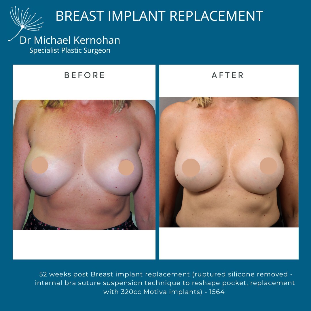 Breast Implant Replacement Before and After Photo - Dr Michael Kernohan - 52 Weeks Post Breast Implant Replacement