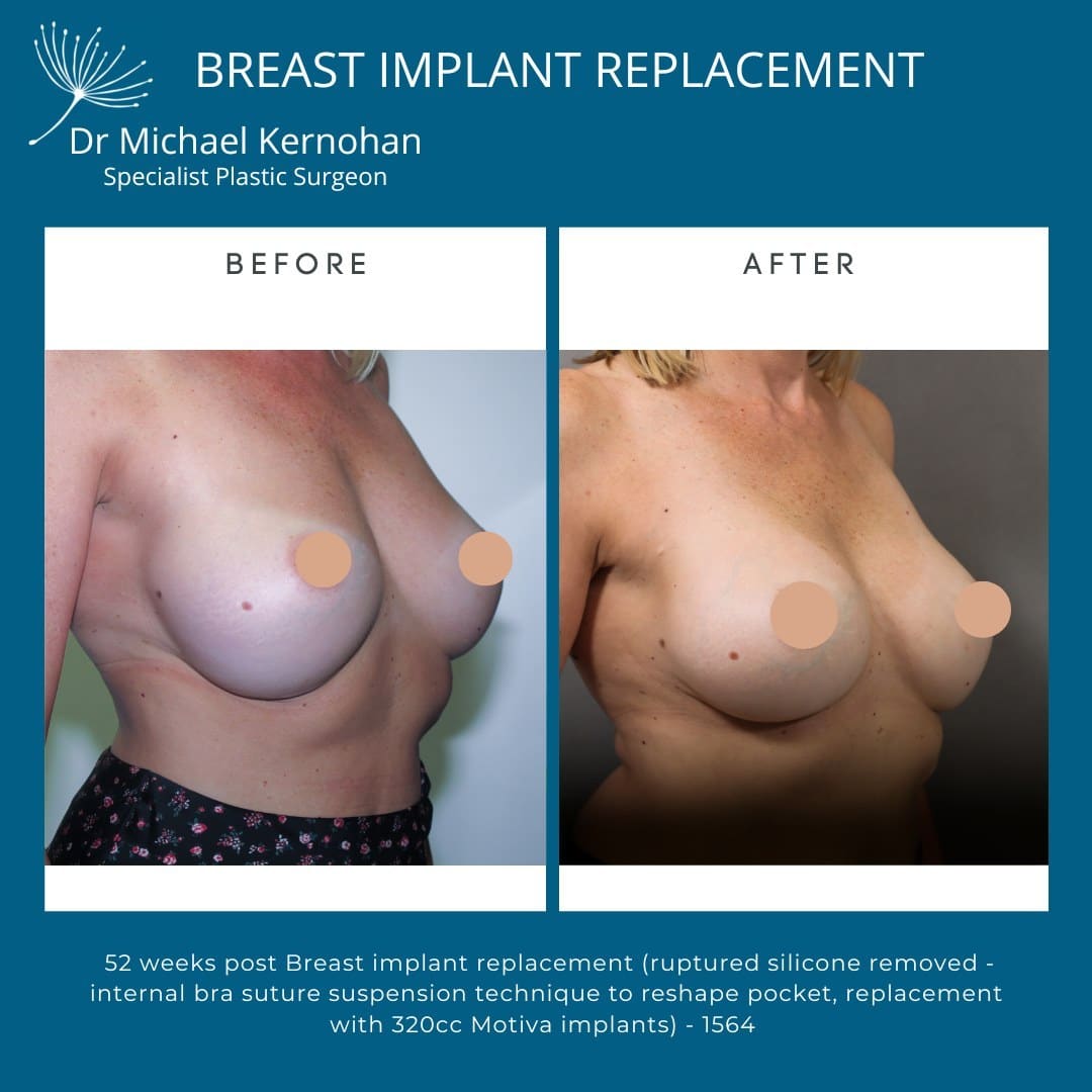 Breast Implant Replacement Before and After Photo - Dr Michael Kernohan - 52 weeks post breast implant Ruptured silicone