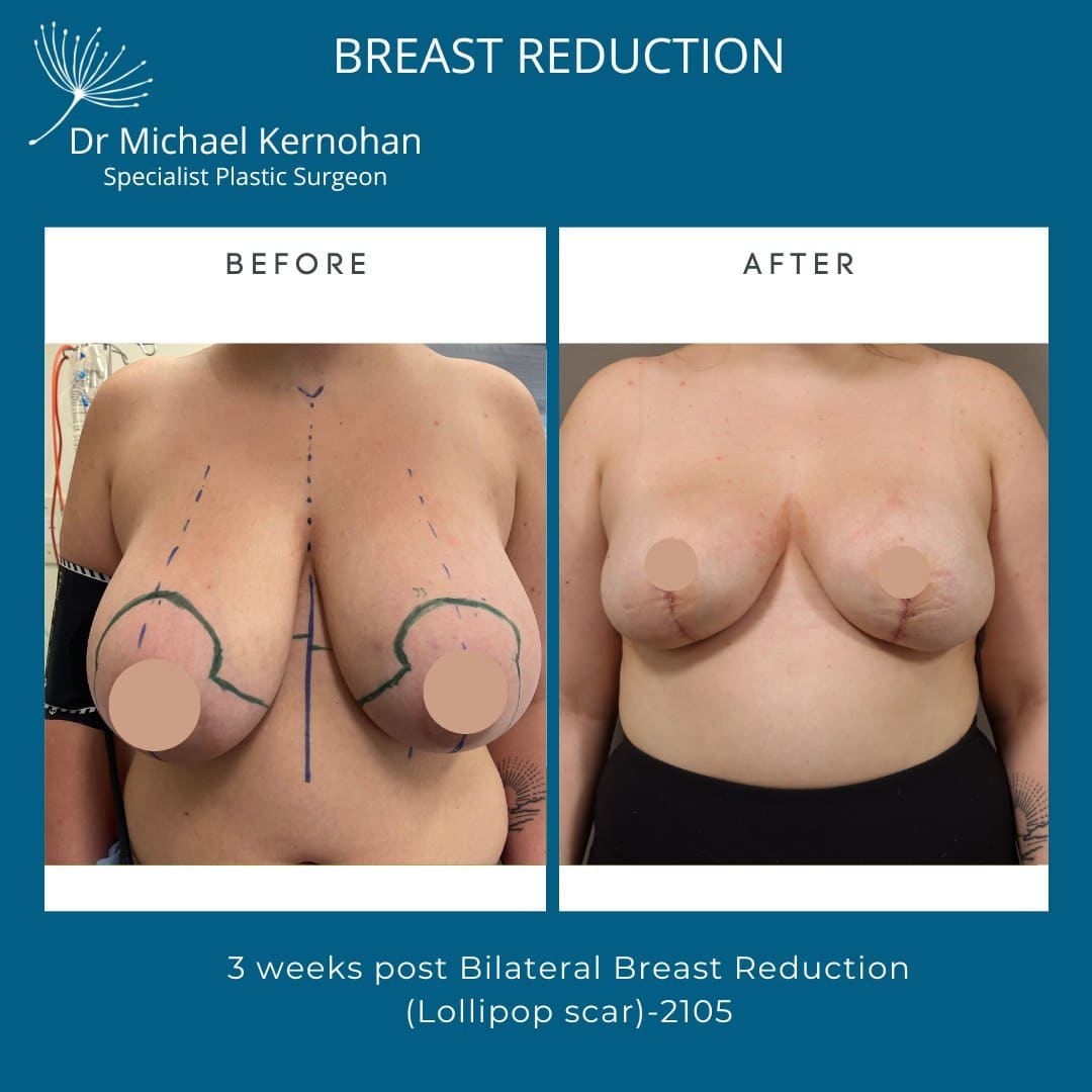 Breast Reduction Before & After Photos - Dr Michael Kernohan 3 Weeks Post Op