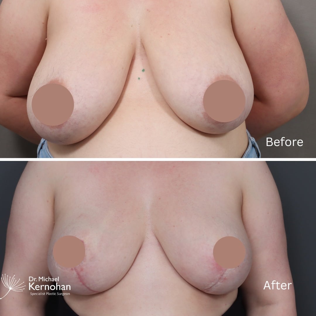 Breast Reduction Before and After Photo - Dr Michael Kernohan - Bilateral Breast Reduction 5 weeks post op Close up Front