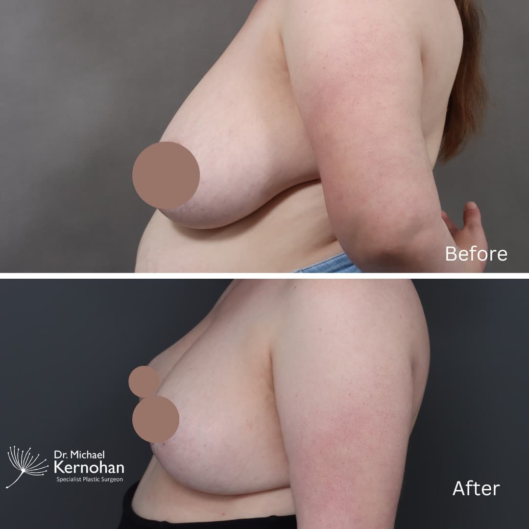Breast Reduction Before and After Photo - Dr Michael Kernohan - Bilateral Breast Reduction 5 weeks post op Close up left