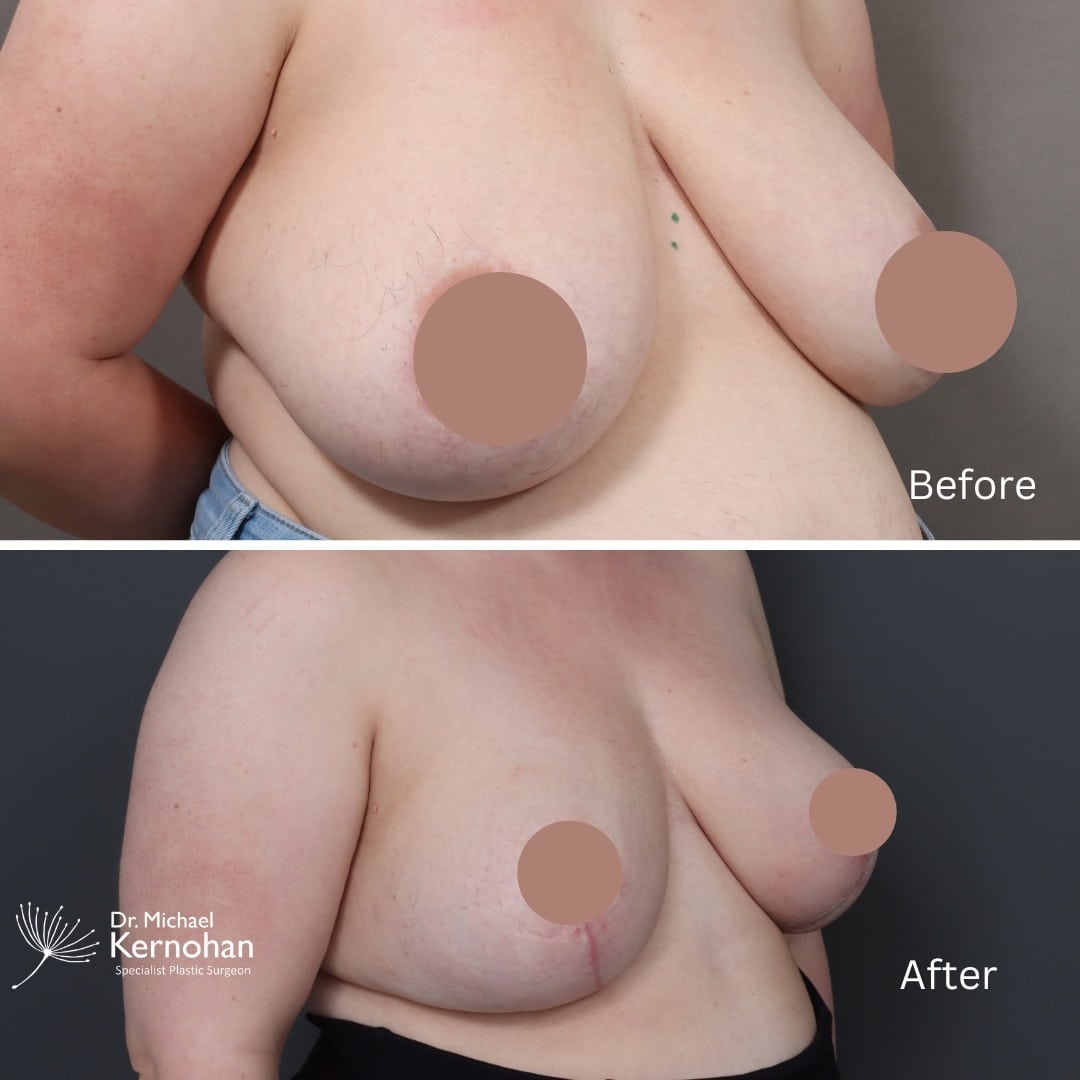 Breast Reduction Before and After Photo - Dr Michael Kernohan - Bilateral Breast Reduction 5 weeks post op Close up right