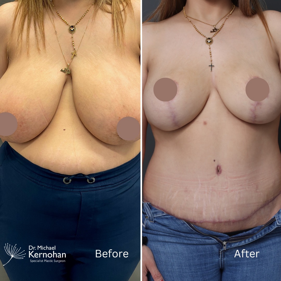 Breast Reduction Before and After Photo - Dr Michael Kernohan - Bilateral Breast Reduction (Lollipop scar - Hall Findlay technique) 4 months post op Full