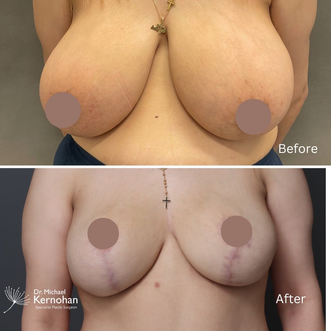 Breast Reduction Before and After Photo - Dr Michael Kernohan - Bilateral Breast Reduction (Lollipop scar - Hall Findlay technique) 4 months post op closeup