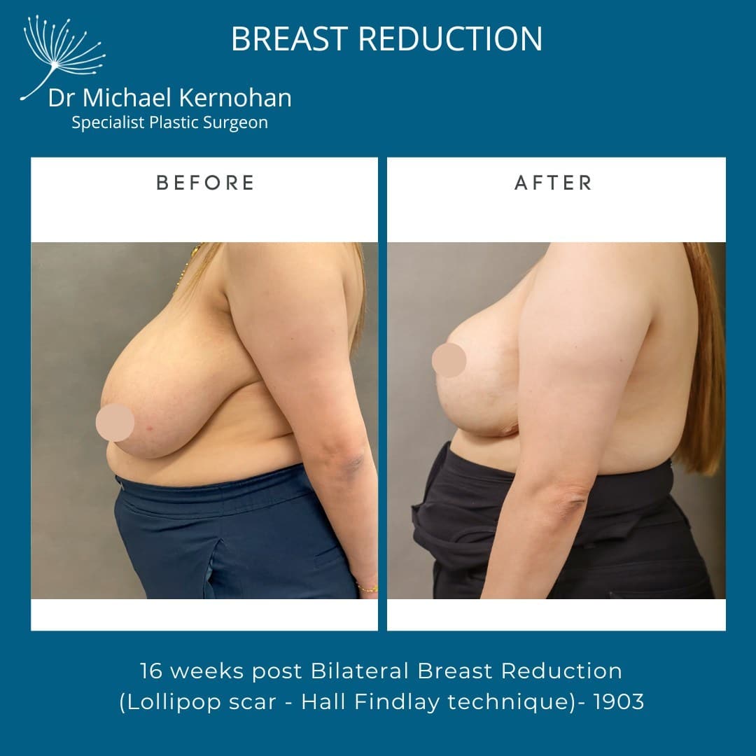 Breast Reduction Before and After Photo - Dr Michael Kernohan - Bilateral Breast Reduction photo 16 weeks post Op Hall Findlay Technique Left