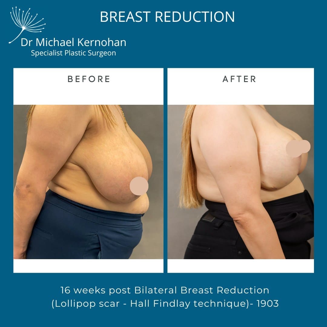 Breast Reduction Before and After Photo - Dr Michael Kernohan - Bilateral Breast Reduction photo 16 weeks post Op Hall Findlay Technique right