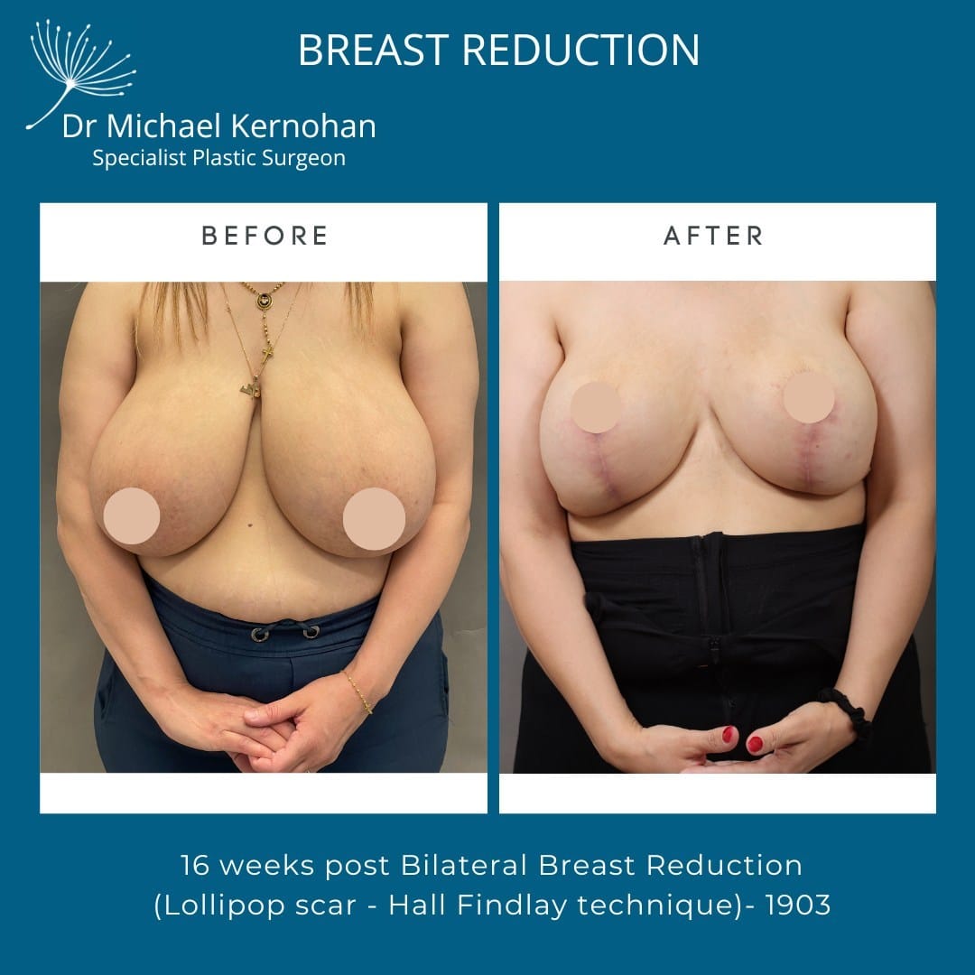 Breast Reduction Before and After Photo - Dr Michael Kernohan - Bilateral Breast Reduction photo 16 weeks post Op Lollipop Scar Reduction
