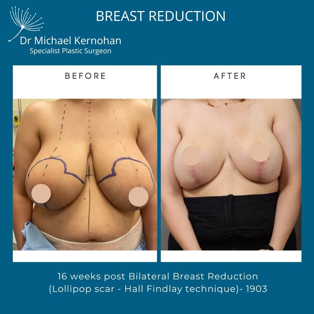 Breast Reduction Before and After Photo - Dr Michael Kernohan - Bilateral Breast Reduction photo 16 weeks post Op Lollipop Scar