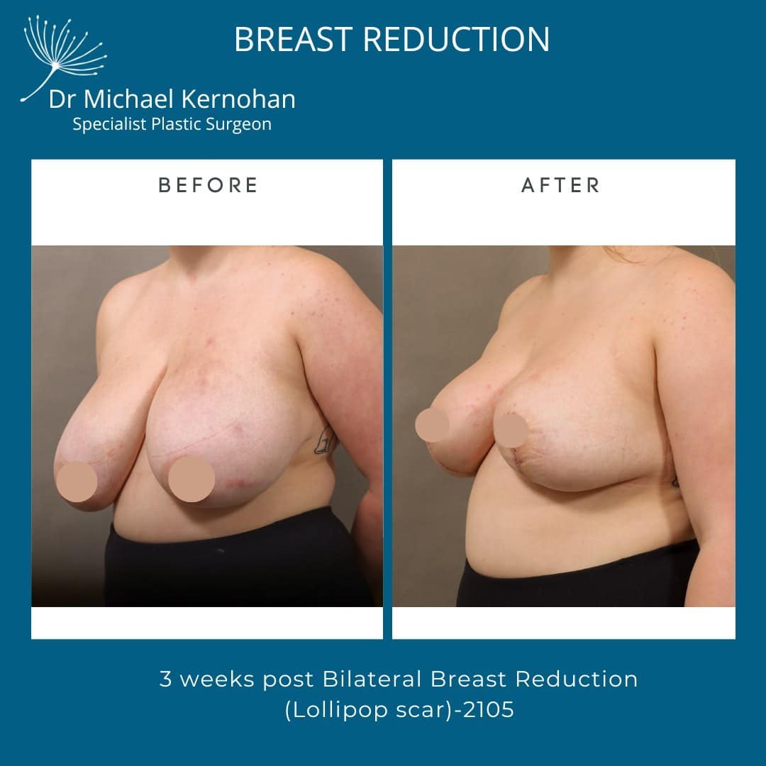 Breast Reduction Before and After Photo - Dr Michael Kernohan - Bilateral Breast Reduction photo taken 3 weeks post op 2105 Angled