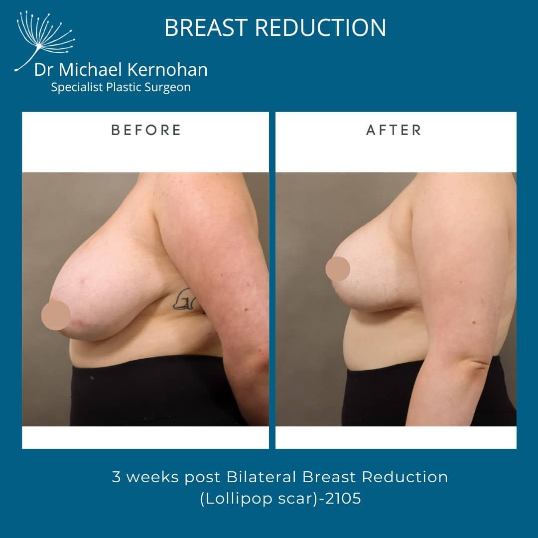 Breast Reduction Before and After Photo - Dr Michael Kernohan - Bilateral Breast Reduction photo taken 3 weeks post op 2105 Side