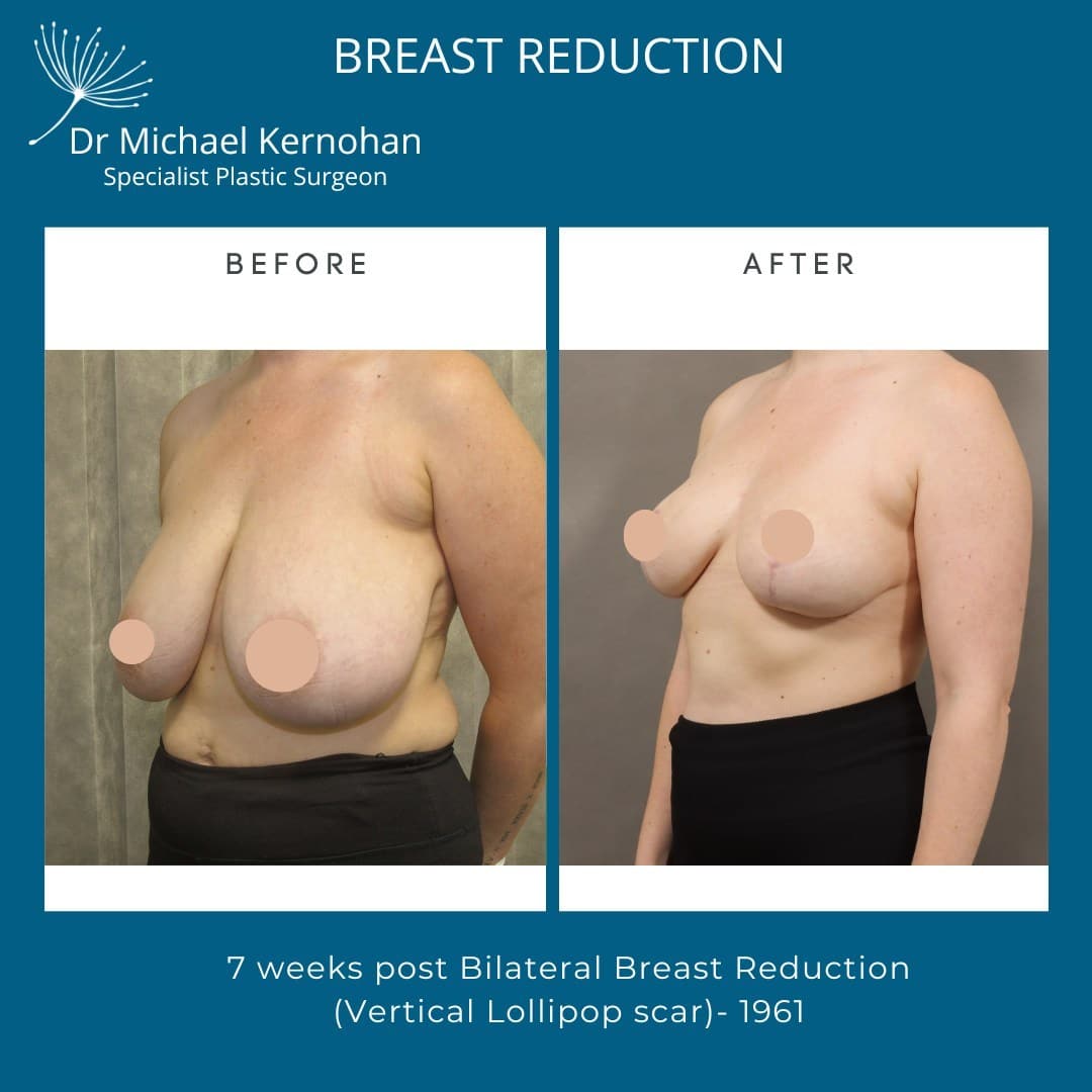 Breast Reduction Before and After Photo - Dr Michael Kernohan - Breast Reduction Result 7 weeks post bilateral breast reduction vertical lollipop scar Angled