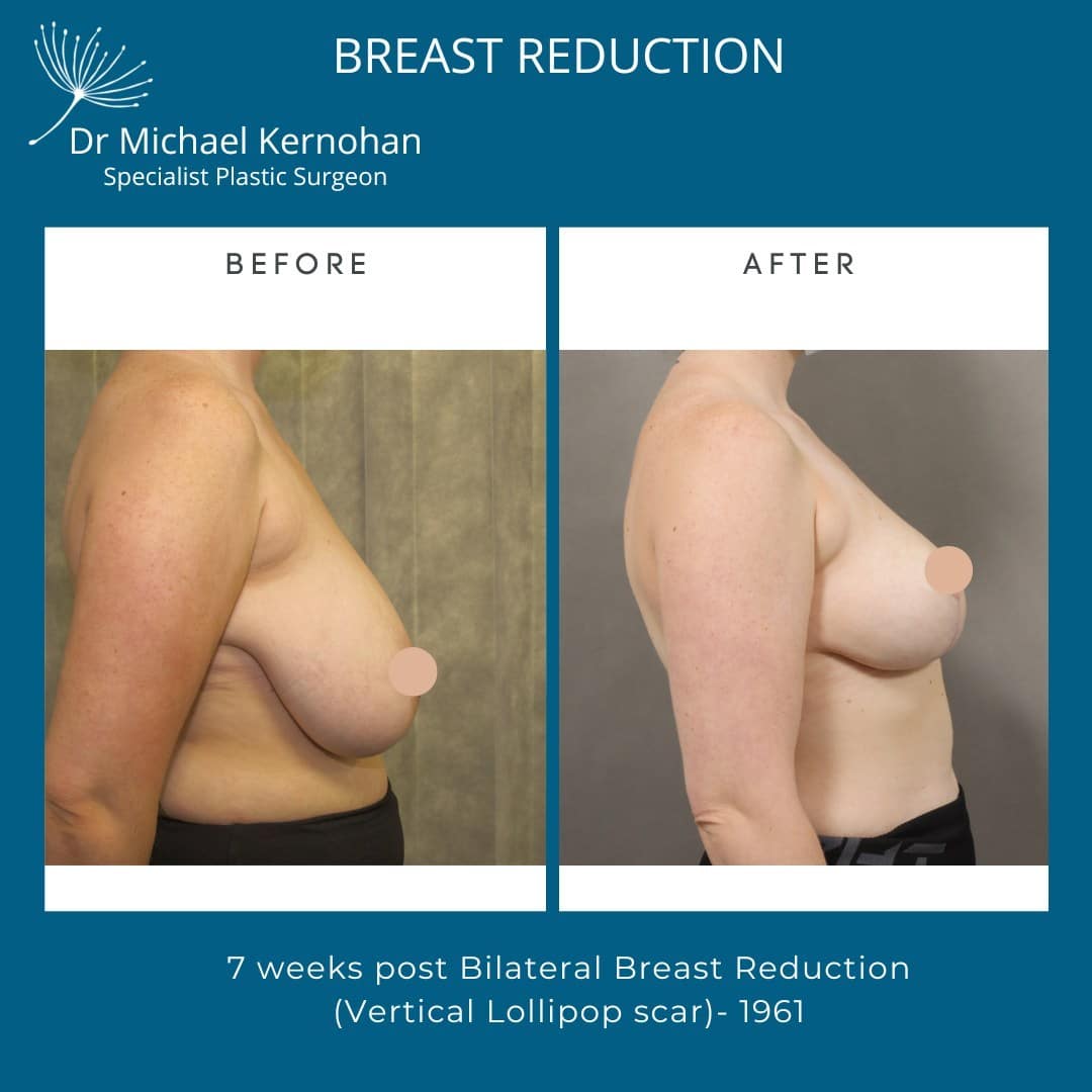 Breast Reduction Before and After Photo - Dr Michael Kernohan - Breast Reduction Result 7 weeks post bilateral breast reduction vertical lollipop scar Full side