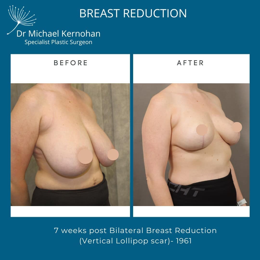 Breast Reduction Before and After Photo - Dr Michael Kernohan - Breast Reduction Result 7 weeks post bilateral breast reduction vertical lollipop scar Side