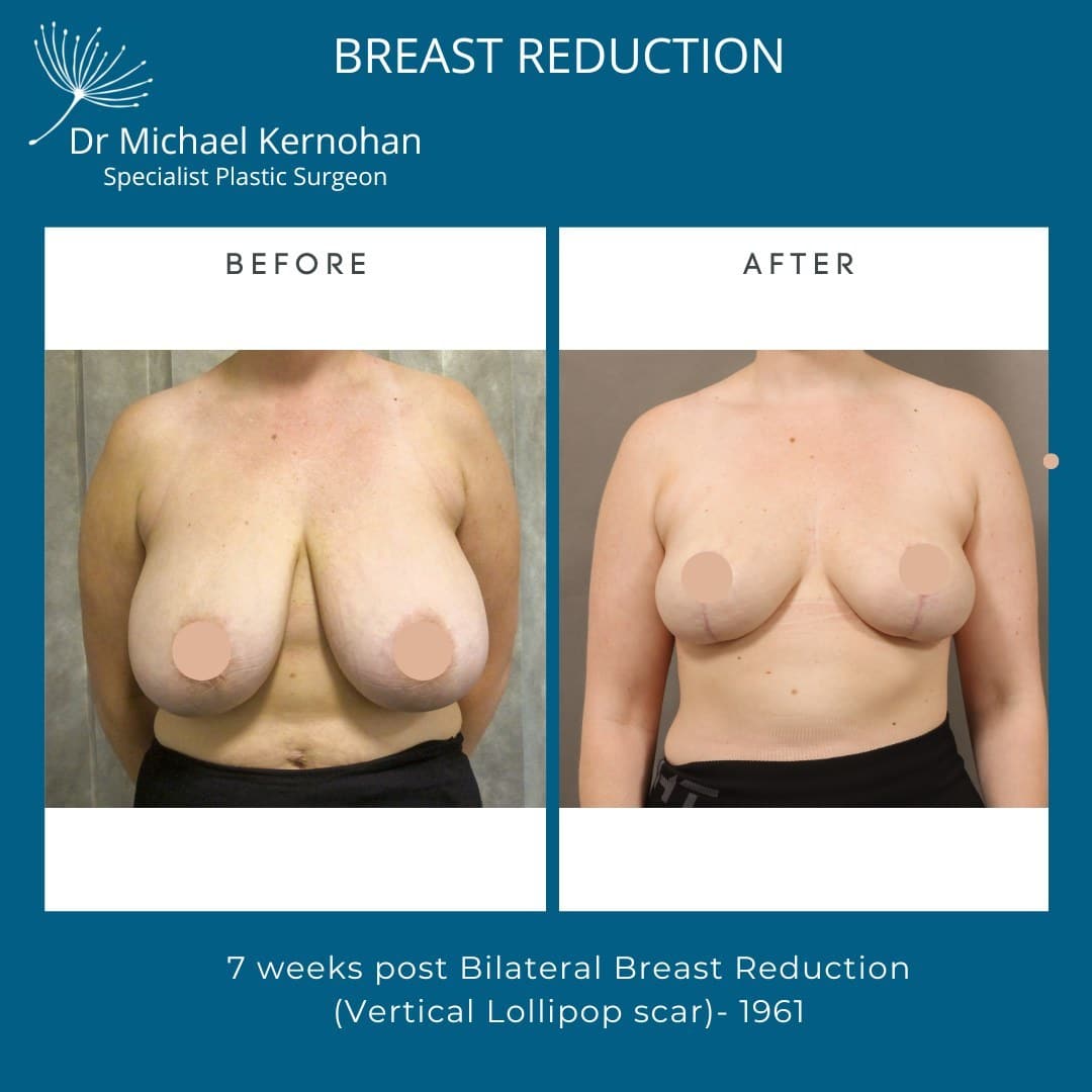 Breast Reduction Before and After Photo - Dr Michael Kernohan - Breast Reduction Result 7 weeks post bilateral breast reduction vertical lollipop scar.
