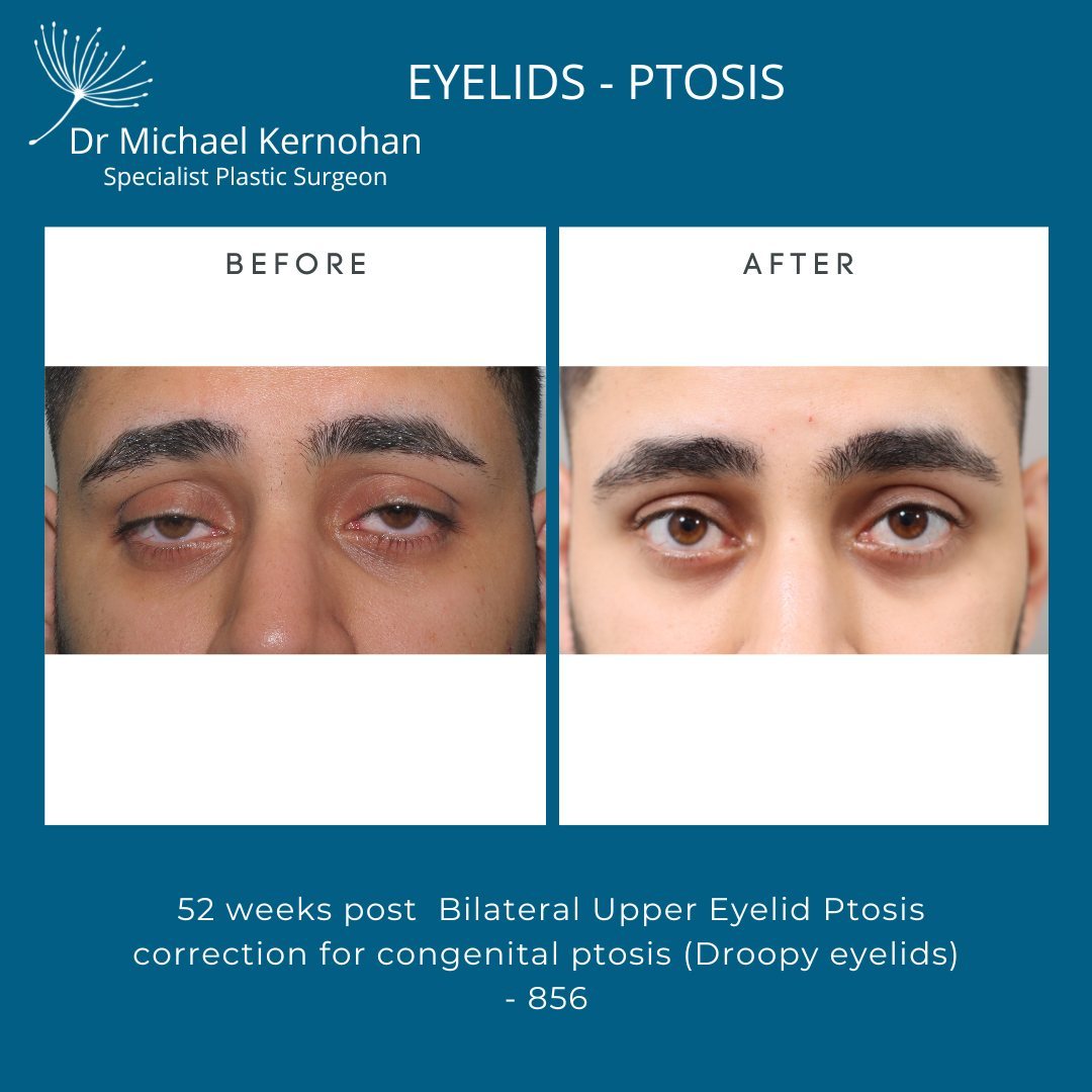 Eye Surgery Before and After Photo - Dr Michael Kernohan - Bilateral eyelid ptosis reconstruction 1 year post-op
