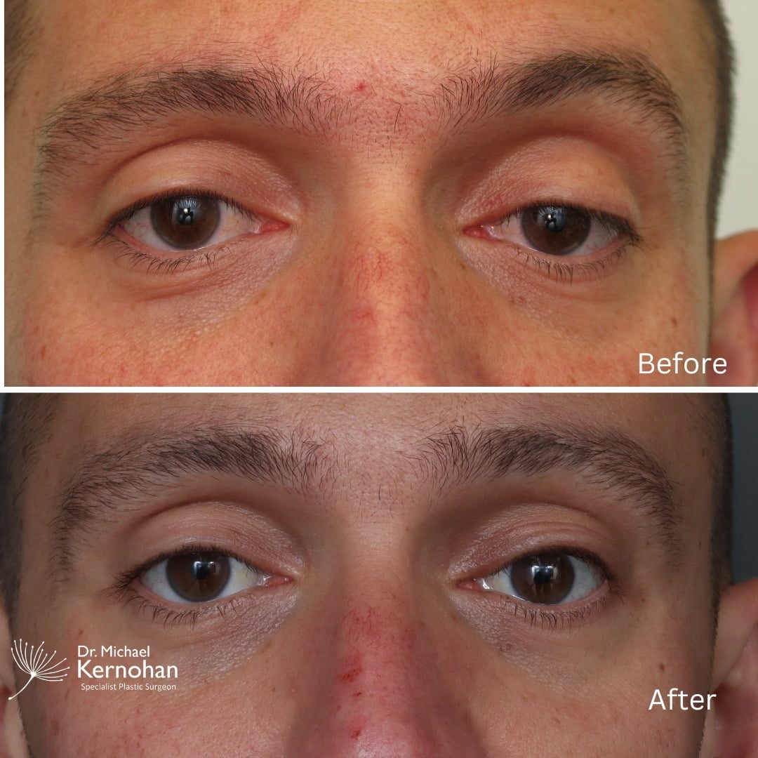 Eye Surgery Before and After Photo - Dr Michael Kernohan - Unilateral eyelid ptosis reconstruction After photo taken at 3 weeks post op