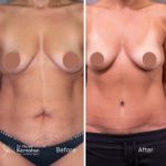Tummy Tuck - Abdominoplasty Before and After Photo - Dr Michael Kernohan - Abdominoplasty, liposuction and fat grafting