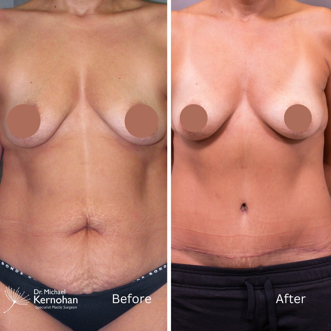 Tummy Tuck - Abdominoplasty Before and After Photo - Dr Michael Kernohan - Abdominoplasty, liposuction and fat grafting