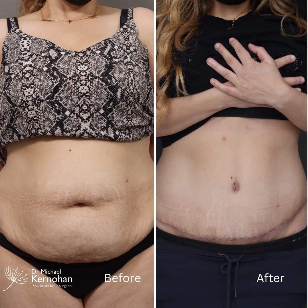Tummy Tuck - Abdominoplasty Before and After Photo - Dr Michael Kernohan - Circumferential abdominoplasty tummy tuck at 4 months