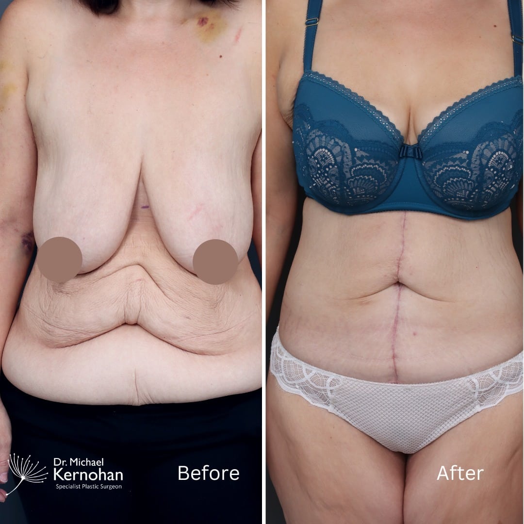 Tummy Tuck - Abdominoplasty Before and After Photo - Dr Michael Kernohan - Corset 360 tummy tuck at 2 Months Post Op