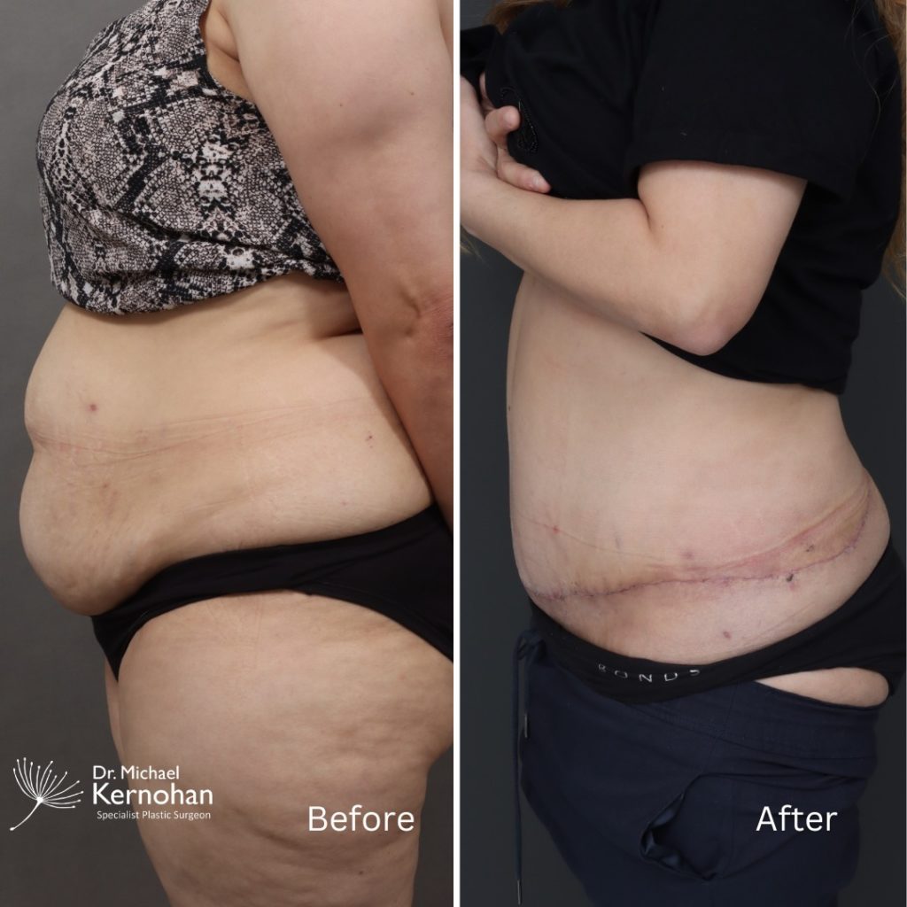 Tummy Tuck - Abdominoplasty Before and After Photo - Dr Michael Kernohan - Side Circumferential abdominoplasty tummy tuck at 4 months
