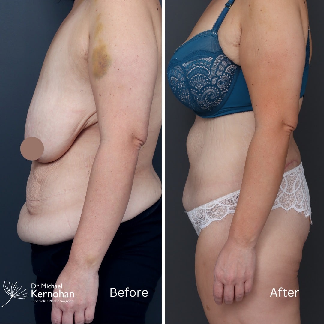 Tummy Tuck - Abdominoplasty Before and After Photo - Dr Michael Kernohan - Sideview Corset 360 tummy tuck at 2 Months Post Op