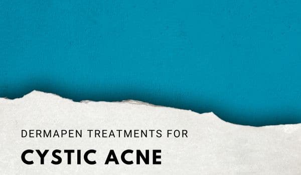 Dermapen Treatments for Cystic Acne