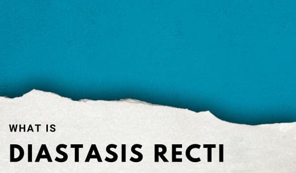 What is diastasis recti