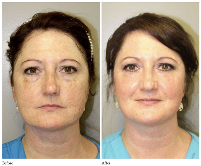 CoolPeel Co2-laser-before-and-after-1-sydney