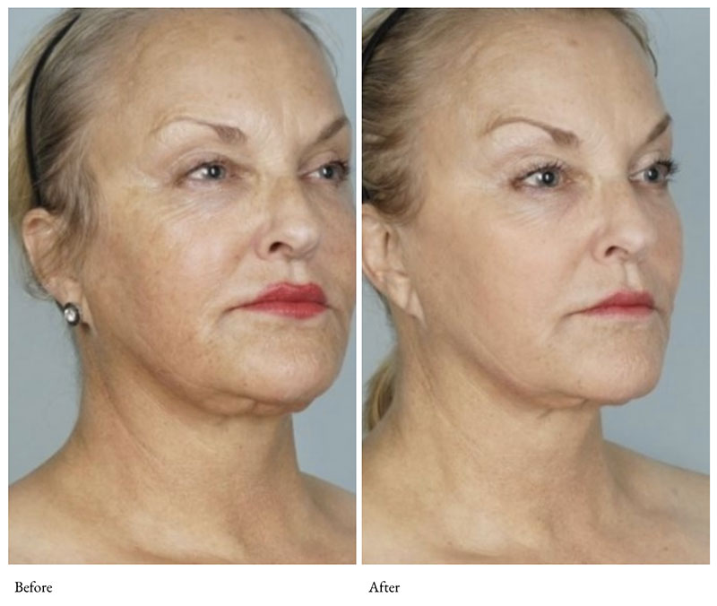 CoolPeel Co2-laser-before-and-after-4-sydney.jpg