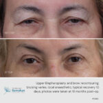 Upper blepharoplasty and brow recontouring before and after.