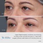 Upper blepharoplasty and brow recontouring before and after.