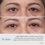Upper blepharoplasty and brow recontouring before and after.