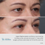 Upper blepharoplasty and brow recontouring before and after.