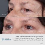 Upper blepharoplasty and brow recontouring before and after.