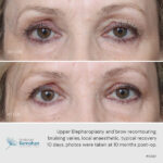 Upper blepharoplasty and brow recontouring before and after.