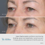 Upper blepharoplasty and brow recontouring before and after.