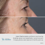 Upper blepharoplasty and brow recontouring before and after.