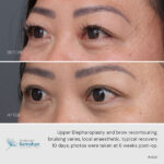 Upper blepharoplasty and brow recontouring before and after.