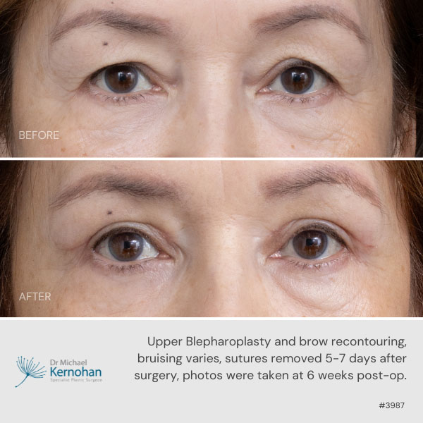 Upper blepharoplasty and brow recontouring before and after.